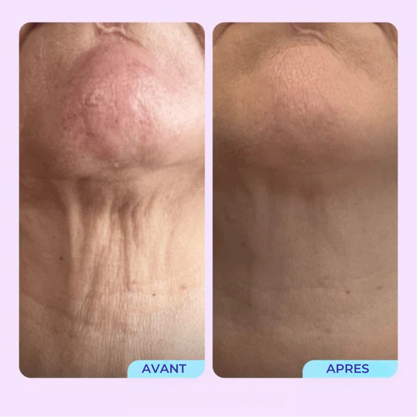 SmoothLift™ Complex — Kalmeris Beauty