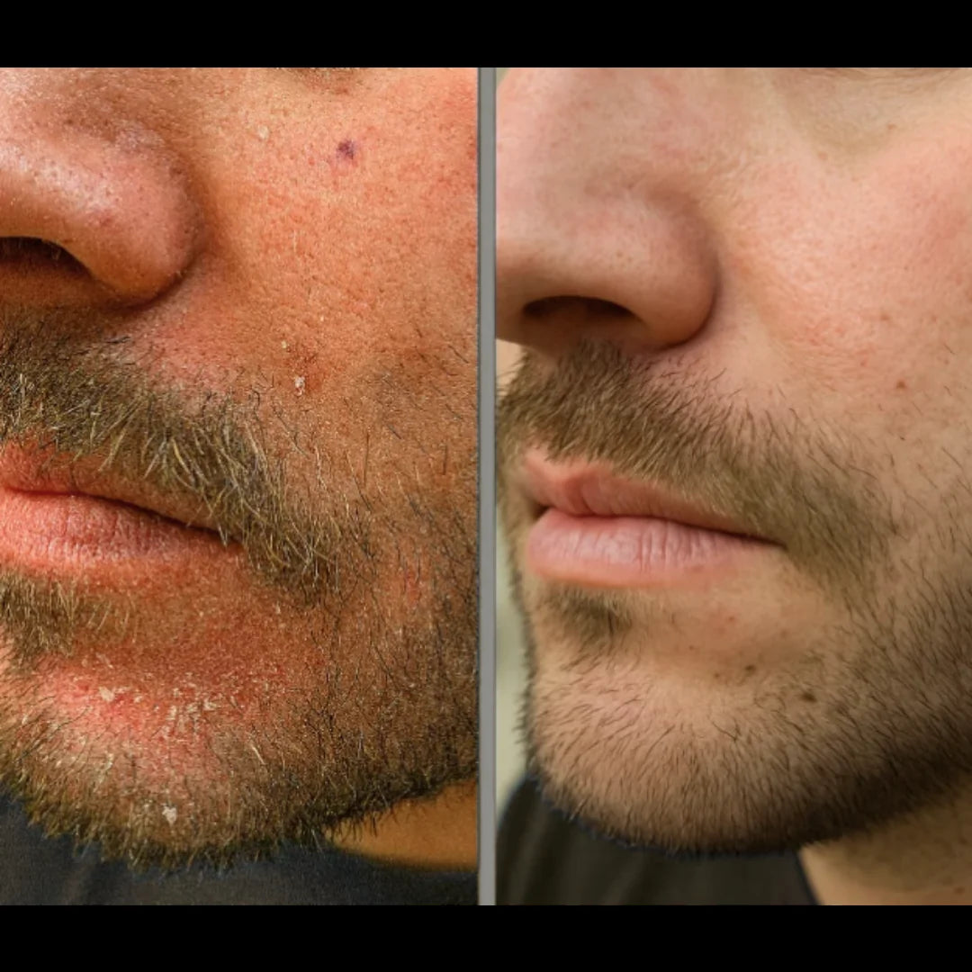 Résultat barbe avec squames