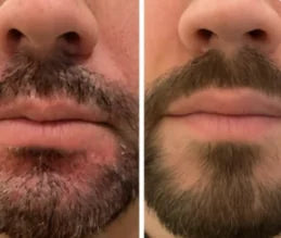 Résultat irritation de la barbe