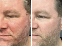 Résultat peau sous la barbe